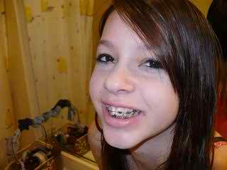 caring for braces